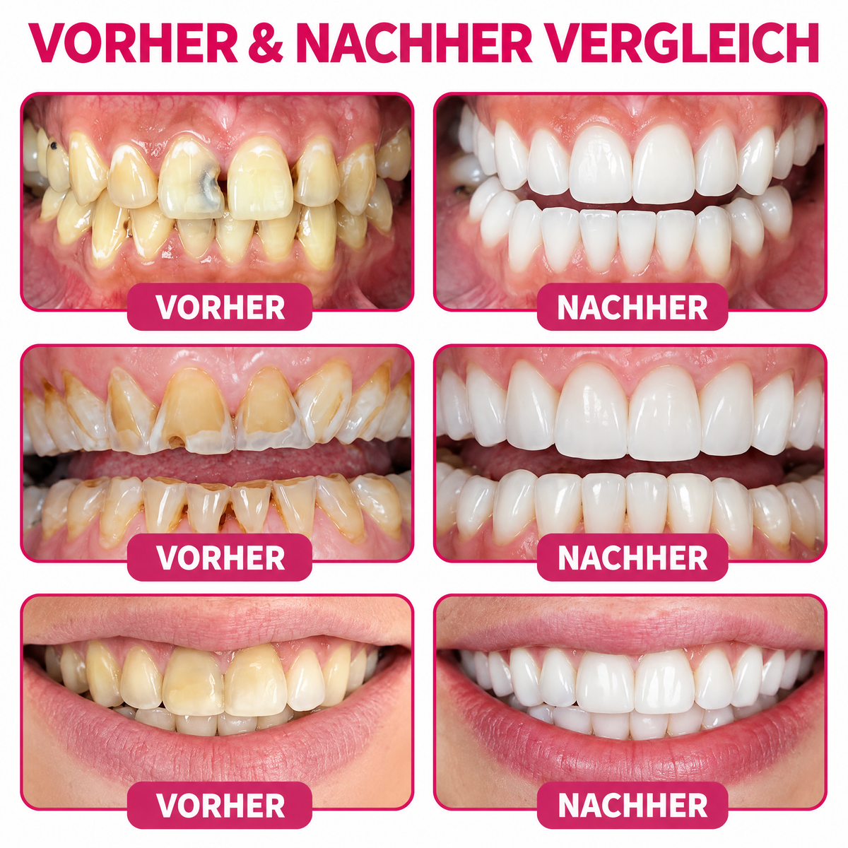 Natürliches Zahnschmelz-Reparaturgel