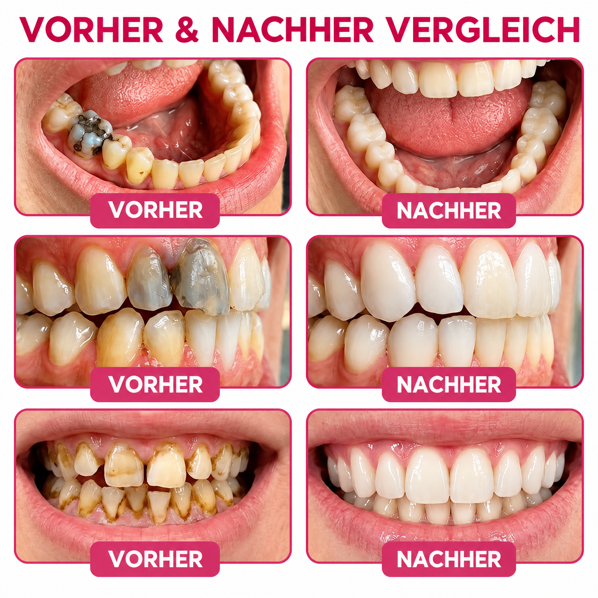 Natürliches Zahnschmelz-Reparaturgel